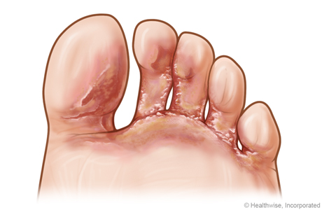 Vasou Podiatry - Athlete's foot (tinea pedis)